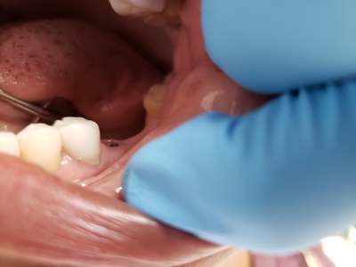 before four unit ceramic implant crown glendora dentist anna lee dds